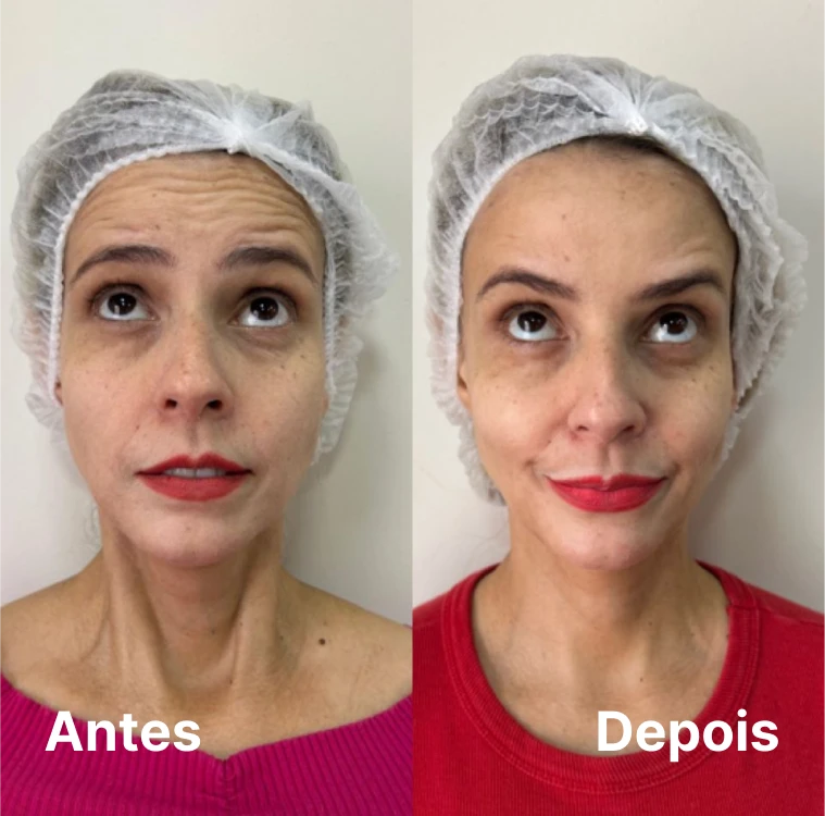 Harmonização facial feminina Goiânia – antes e depois