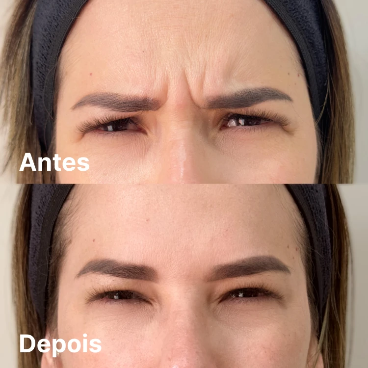 Antes e depois de botox na testa em Goiânia – Clínica Além do Olhar