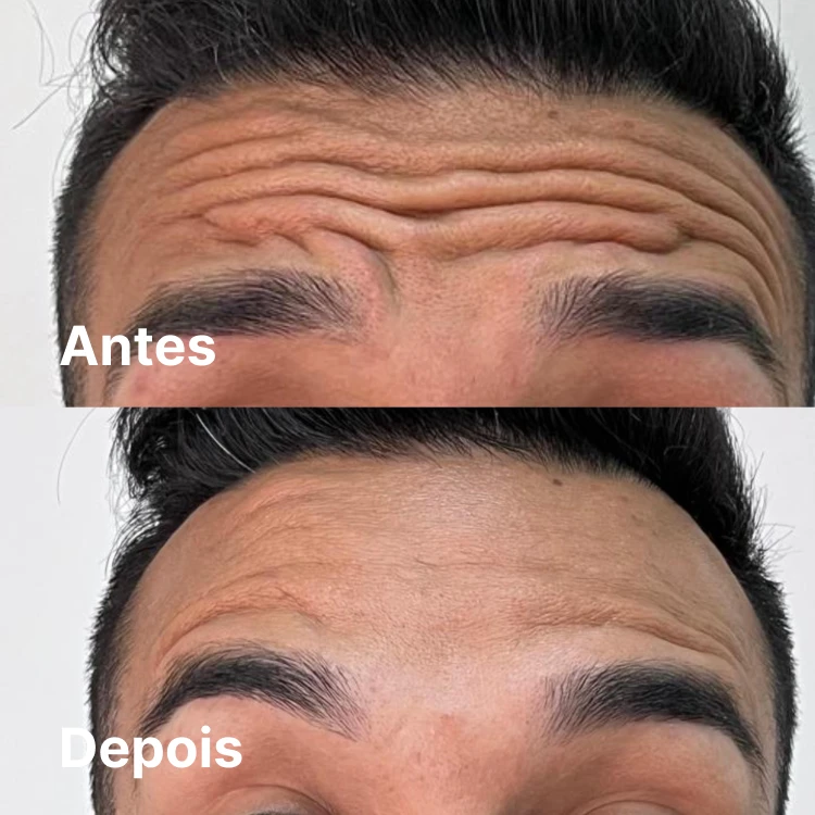 Antes e depois de botox masculino na testa em Goiânia