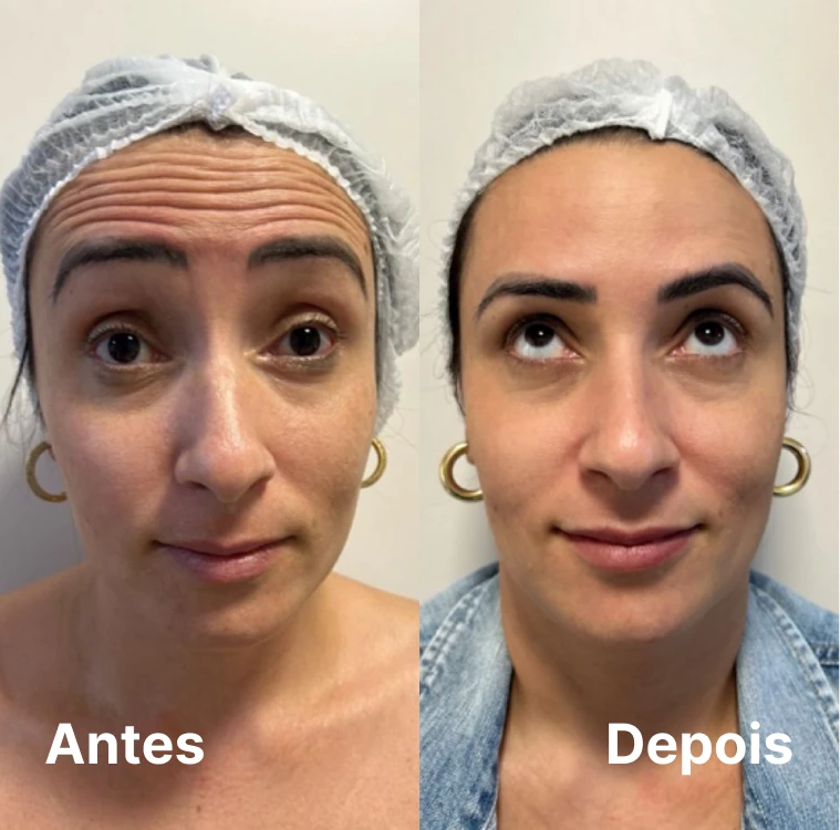 Harmonização facial – resultado em dupla de pacientes no Setor Oeste