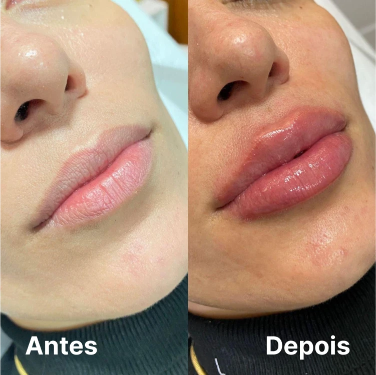 Preenchimento labial em Goiânia – resultado natural