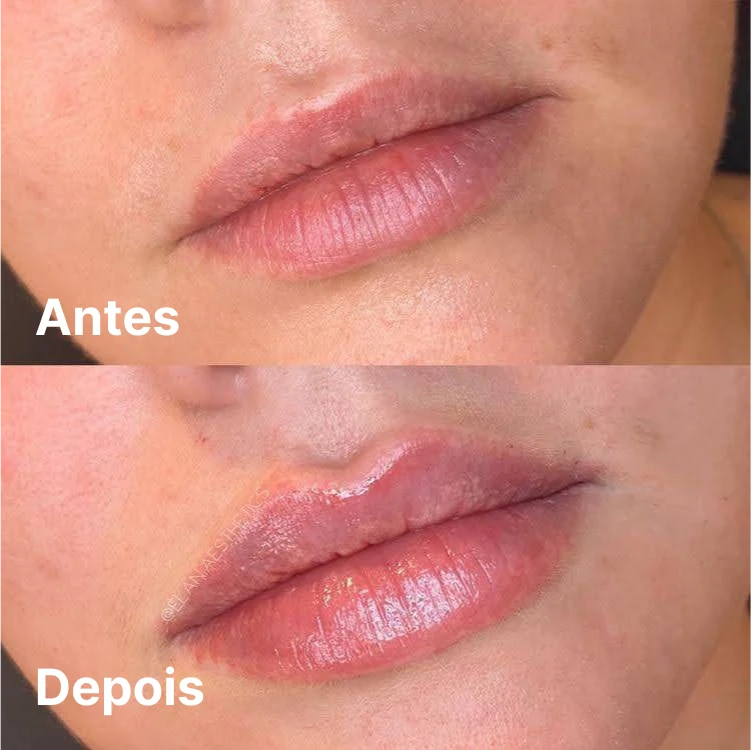 Detalhe do preenchimento labial em Goiânia – volume com naturalidade