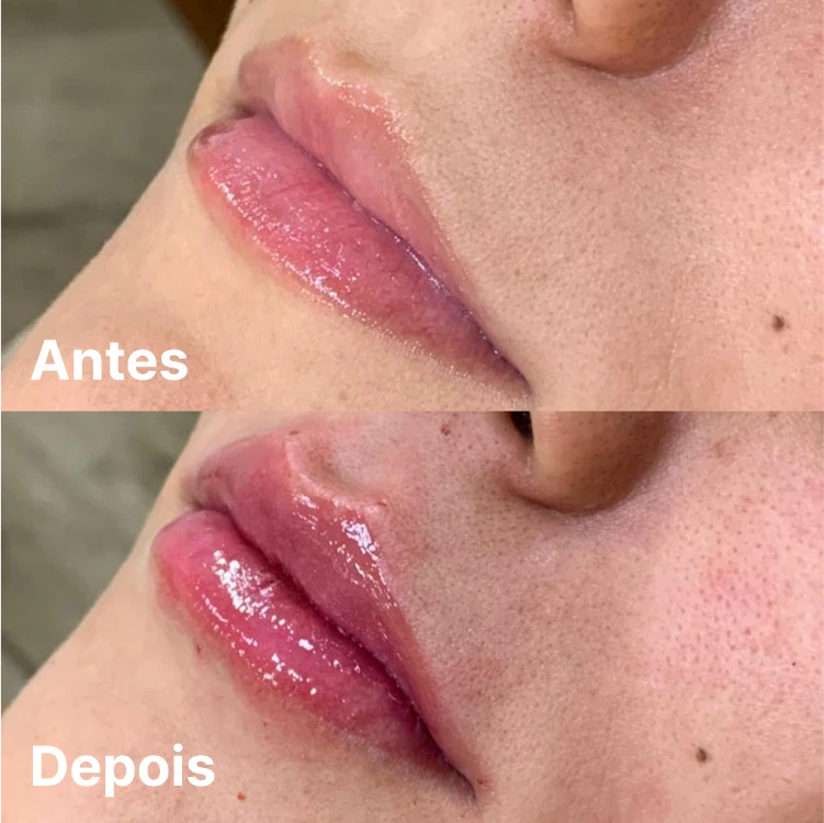 Detalhe do preenchimento labial em Goiânia – volume com naturalidade