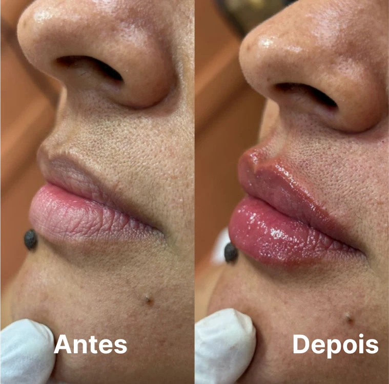 Resultado de preenchimento labial com contorno definido em Goiânia